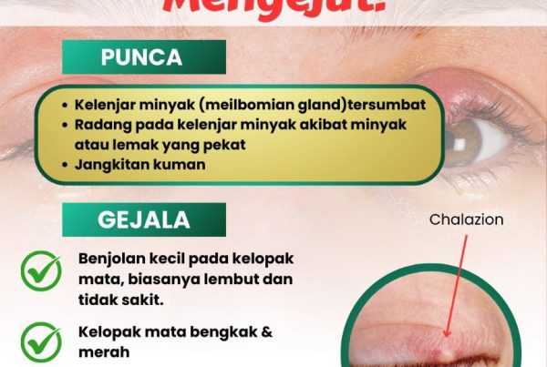 Cara Hilangkan Ketumbit Dengan Cepat Dan Selamat